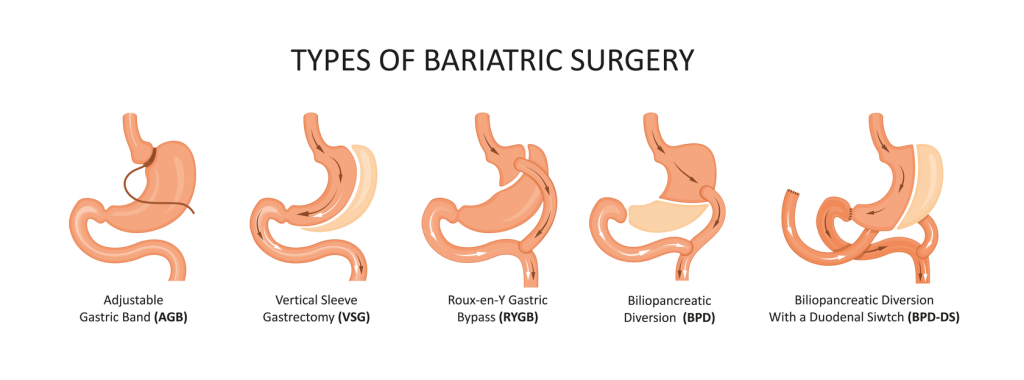 Types of Bariatric Surgery